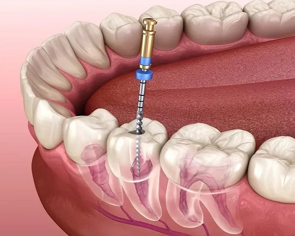root-canal
