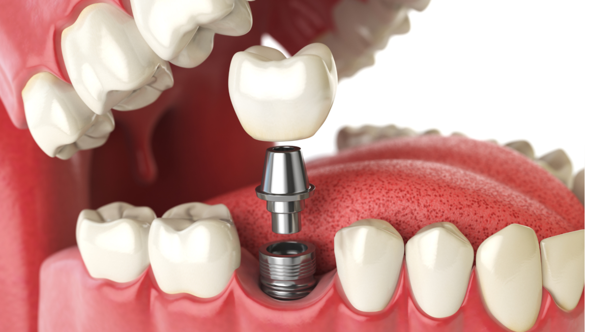 implant_dentistry