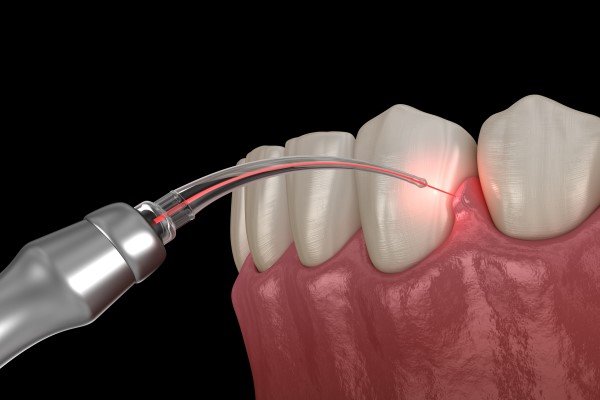 laser-dentistry