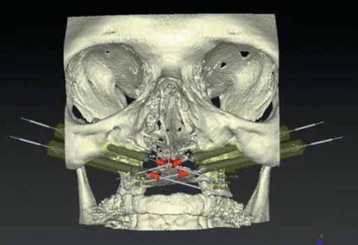 Zygomatic-Implants