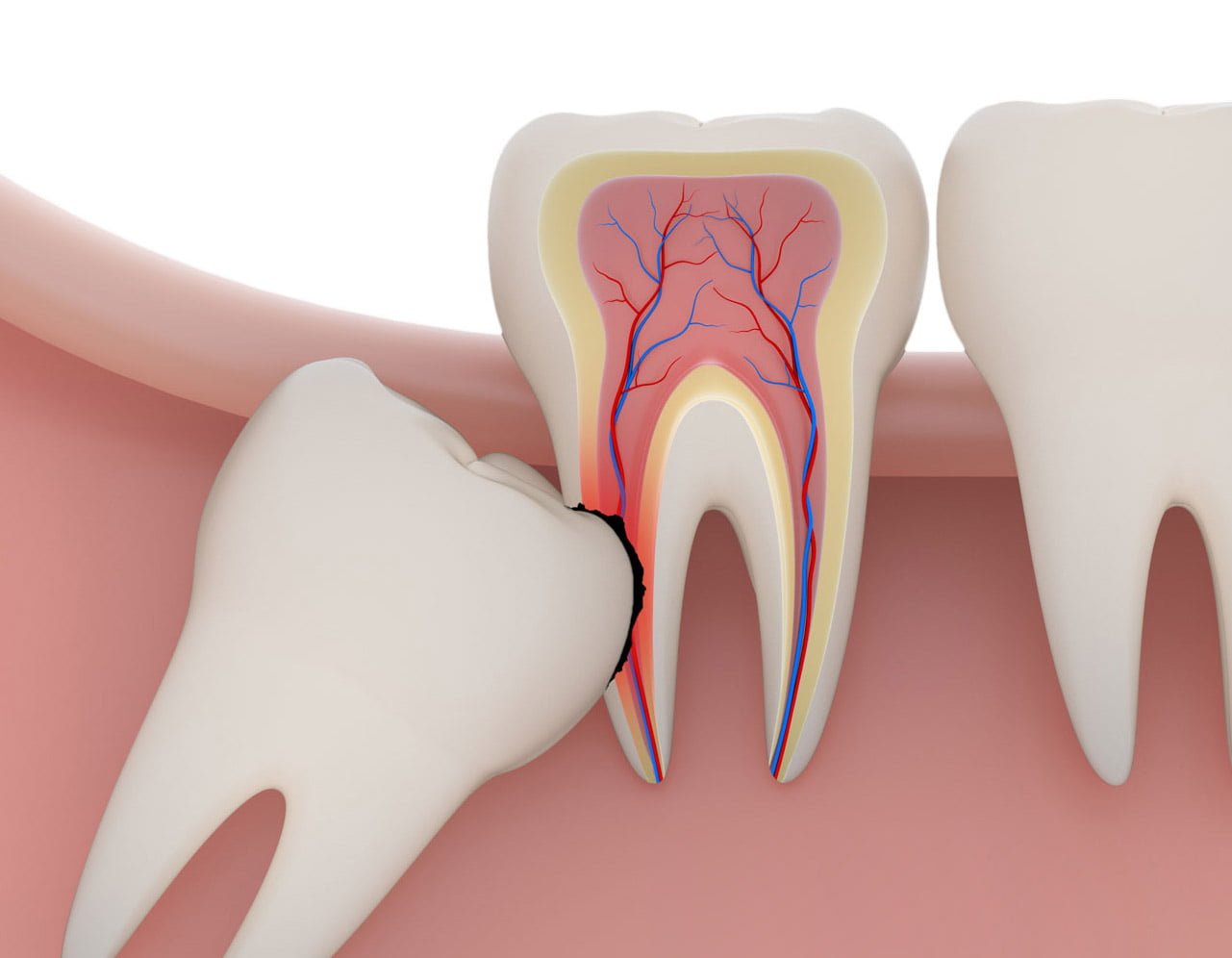 wisdom-tooth-removal-saritha-dental