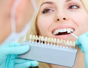Dental veneers Image